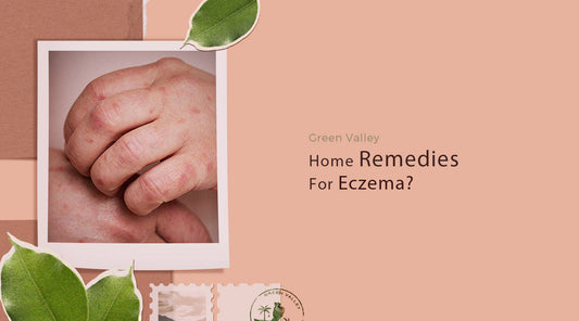 Home Remedies for Eczema (Atopic Dermatitis)