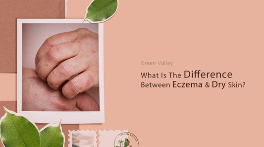 What’s The Difference Between Eczema And Dry Skin?